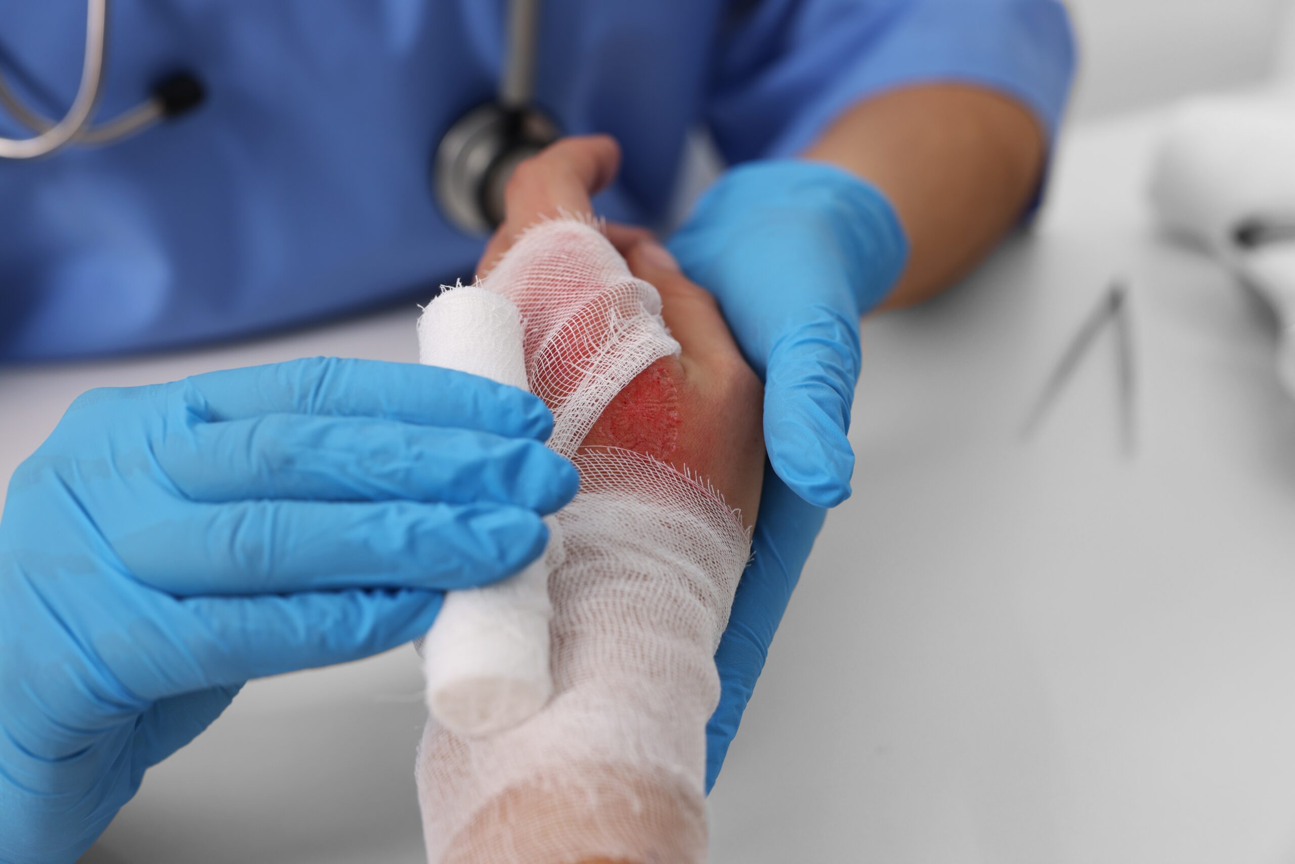 Doctor,Bandaging,Patient’s,Burned,Hand,At,Table,,Closeup